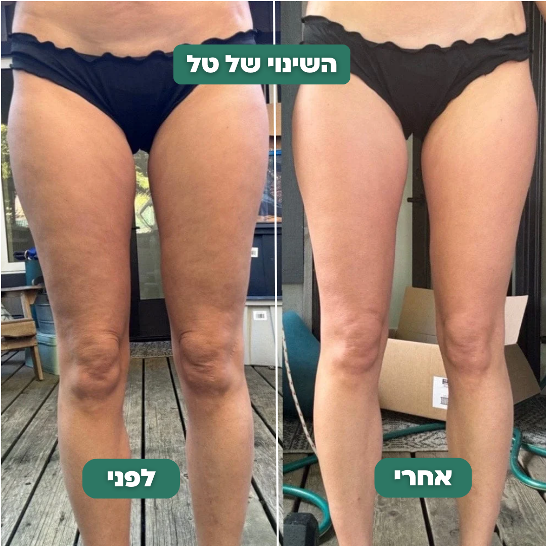 מכשיר להעלמת צלוליט - CelluPro™