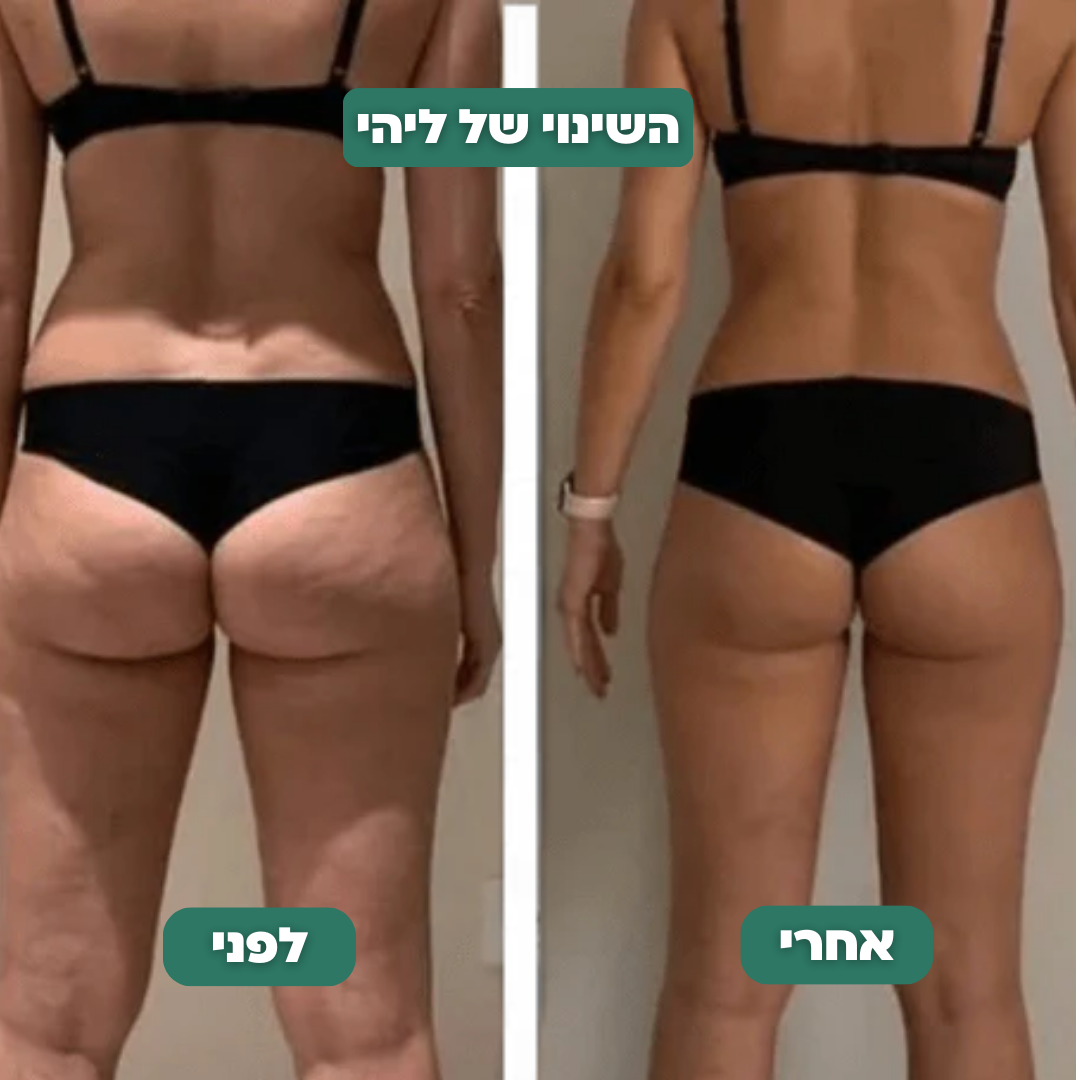 מכשיר להעלמת צלוליט - CelluPro™